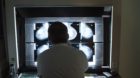 A radiologist looks at x-rays of a woman's breast at the Clinic Engeried in Bern, Switzerland, pictured on December 8, 2009. 